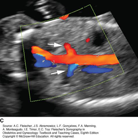 The Fetal Genitourinary System Obgyn Key