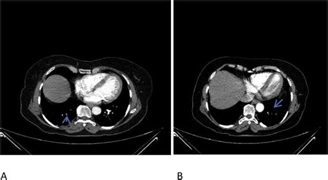 Troublesome Cough As The Sole Manifestation Of Pulmonary Embolism Pmc