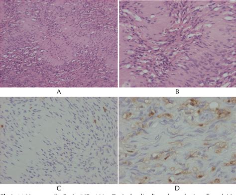 Pdf Schwannoma Of The Third Ventricle A Case Report Semantic Scholar