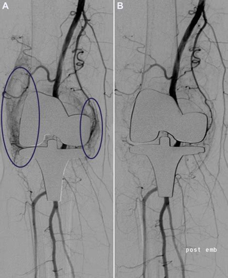 Geniculate Artery Embolization In Patients With Recurrent Hemarthrosis