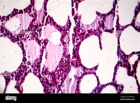 Histopathology Of Pneumonia Light Micrograph Photo Under Microscope