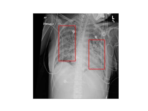 Pneumonia Detection Using Deep Learning Devpost