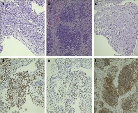 Histopathology Of A Tumor Arising From The Right Lung Of An Infant A