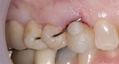 Improve Restorability With Orthodontic Extrusion Decisions In Dentistry