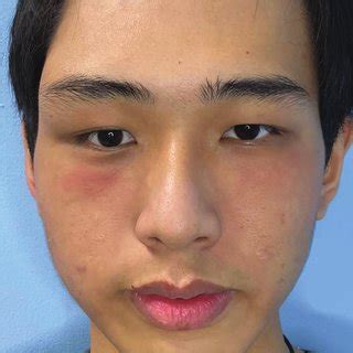 Clinical Presentation Showing A Right Orbital Mass Caused Exophthalmos