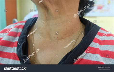 Swollen Neck Thyroid