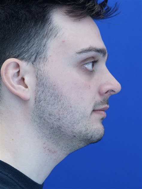 Cases In Rhinoplasty Male Mao Facial Plastics