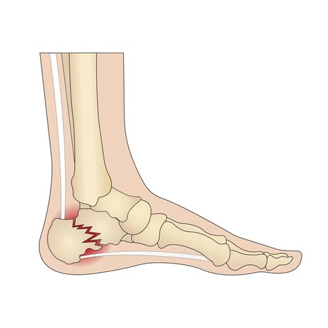 Calcaneus fracture. Foot injury 55746316 Vector Art at Vecteezy