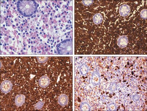 Extranodal Marginal Zone B Cell Lymphoma Of MALT From Case 13 A