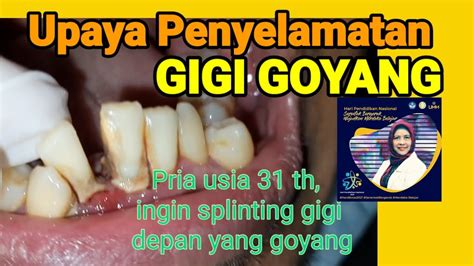 Splinting Darurat Upaya Penyelamatan Gigi Goyang Youtube