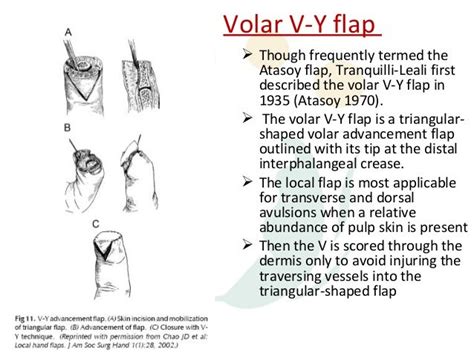Flaps in-the-hand