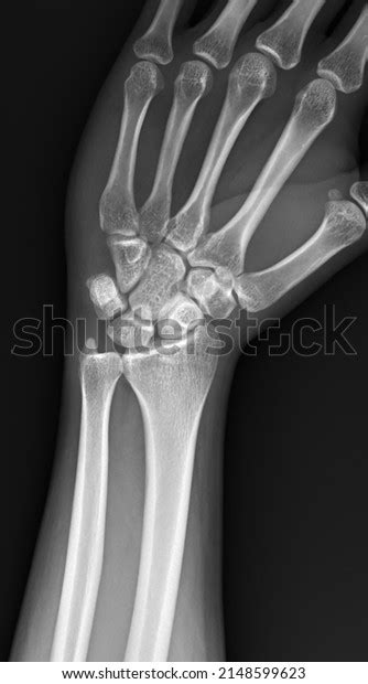 Xray Image Wrist Position Radial Deviation Stock Photo 2148599623 ...