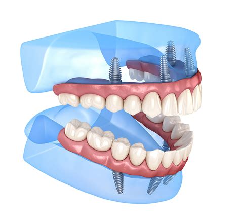 All On X Dental Implants Concord Ca Willow Pass Dental Care