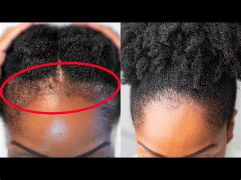 Grow Back Your Edges Fast With These Simple Tips Youtube Growing