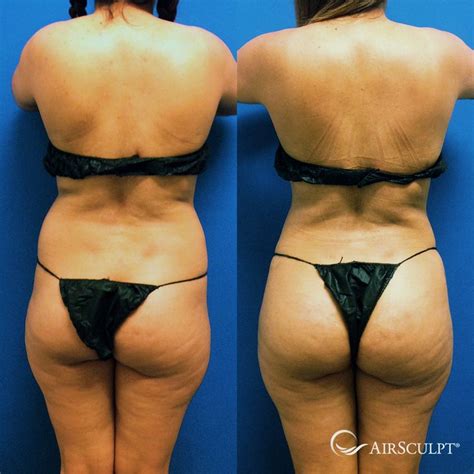 Pin On Airsculpt® Before And After Elite Body Sculpture