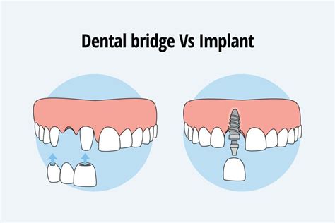 Bridges Vs Implants Which Is The Best Choice For You Chicago