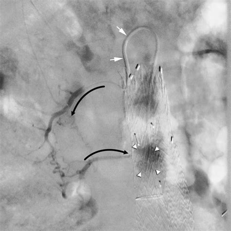 Paraplegia Due To Spinal Cord Ischemia After Endovascular Treatment Of