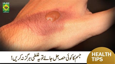 How To Treat Burn Skin Never Make This Mistake After Burning Dr Uzma Hameed Masalatv