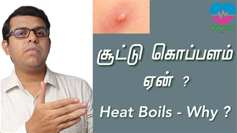 சூட்டு கொப்பளம் ஏன் Heat Boils Why தமிழ் Youtube