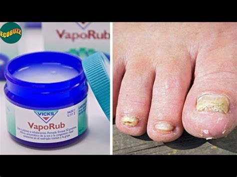 Como Aplicar Vick Vaporub Para Los Hongos Delas Uñas Tienda madre tierra