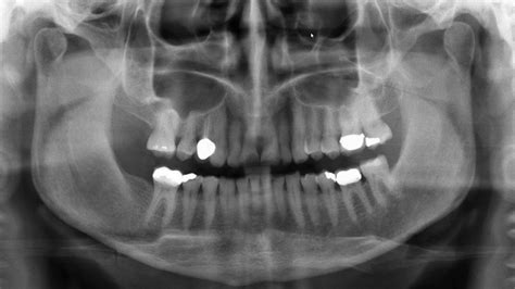 Panoramic Anatomy Identification