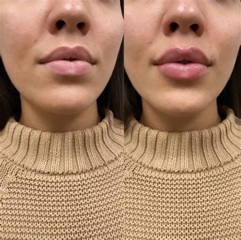 Lip Fillers Injections Upper East Side Nyc Neinstein Plastic Surgery