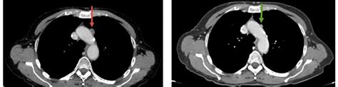 Enhanced Axial Ct Image Showing An Enlarged Mediastinal Lymph Node At A Download Scientific