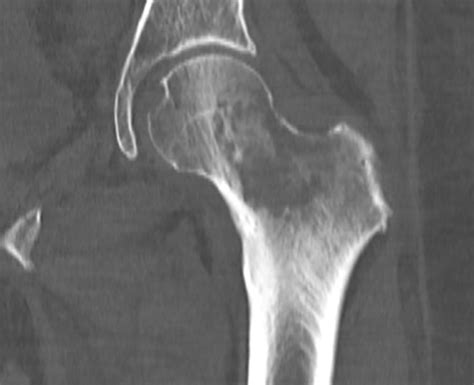 Femoral Neck Metastases From Malignant Melanoma The Bmj