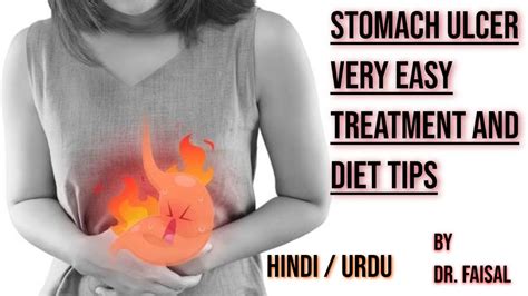 Cure For Stomach Ulcer A Stomach Ulcer Diet Plan Symptoms To Stomach Ulcer Doctor Faisal