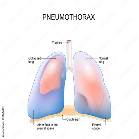 Collapsed Lung