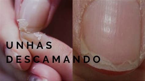 O Que Fazer Quando As Unhas Descamam - UNHAS QUE DESCAMAM - POR QUE E COMO TRATAR? - YouTube