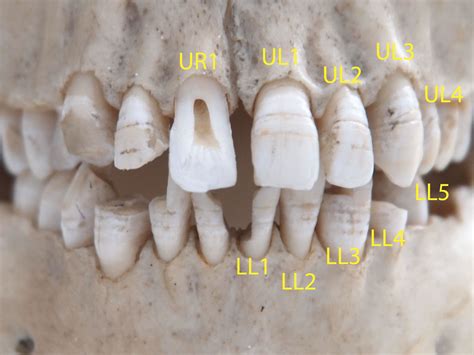 Dental Age Estimation » Anatomy – Permanent Dentition