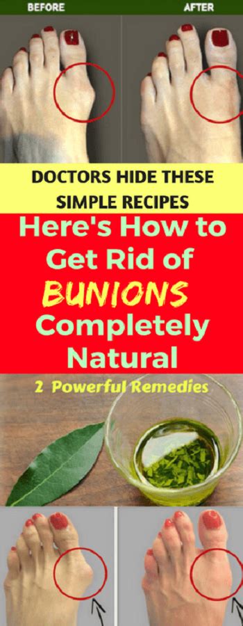 Get Rid Of Bunions Naturally With This Simple But Powerful Remedy Get