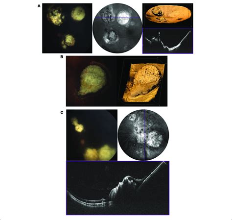 Retinoblastoma Evaluated With Oct In Three Patients With Bilateral Download Scientific