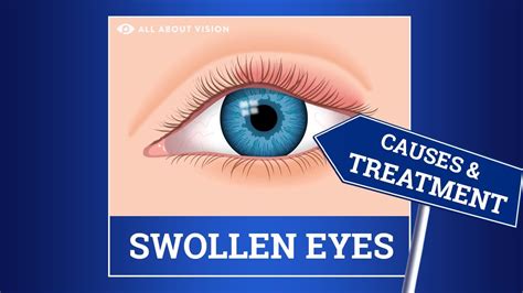 How To Reduce Swelling On Eyelid Sadconsequence Giggmohrbrothers