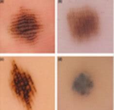 Acral Lentiginous Melanoma - Pictures, Symptoms, Causes, Treatment ...