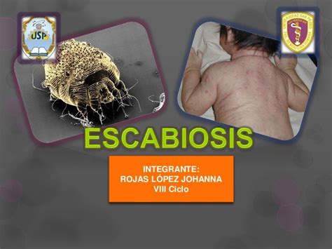 Escabiosis