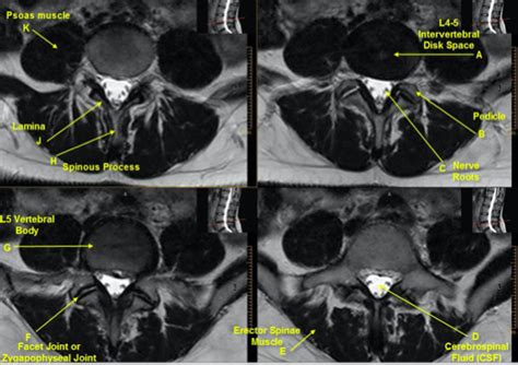 Post Contrast T1 Weighted Transverseaxial Lumbar Spine Diagram Quizlet