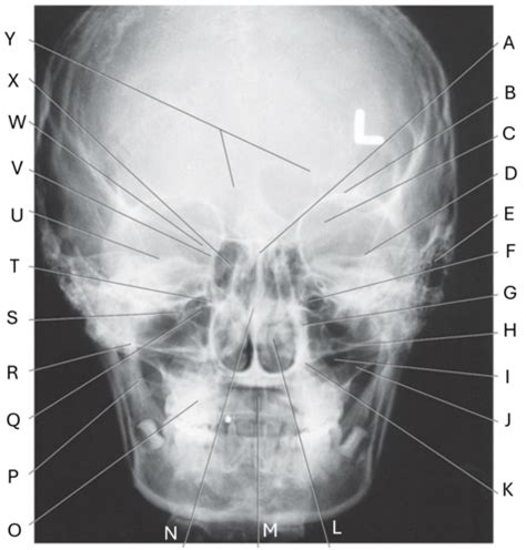 Radiology Frontal Radiograph Flashcards Quizlet