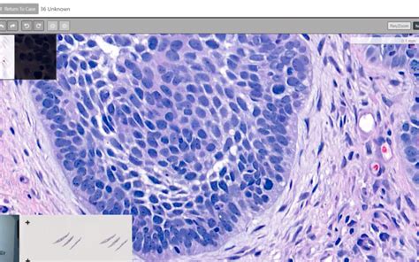 How Well Do You Know Basal Cell Carcinoma PathologyWatch