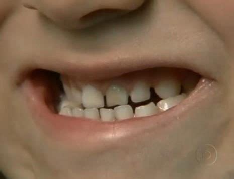 Foto De Criança Dente Podre Relacionado a Crianças