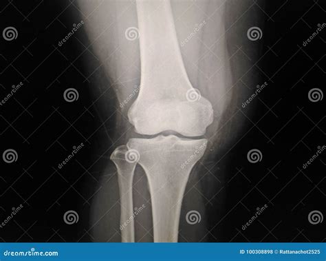 X Ray Knee Ap Normal Radiography Of The Knee Joint Medical Diagnostics