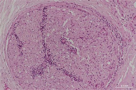 Paraffin Embedded Transverse Section Of One Fascicle Of The Nerve