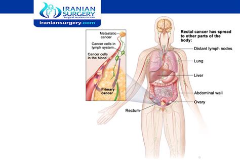 what is stage 3 rectal cancer? | Can Stage 3 rectal cancer be cured?