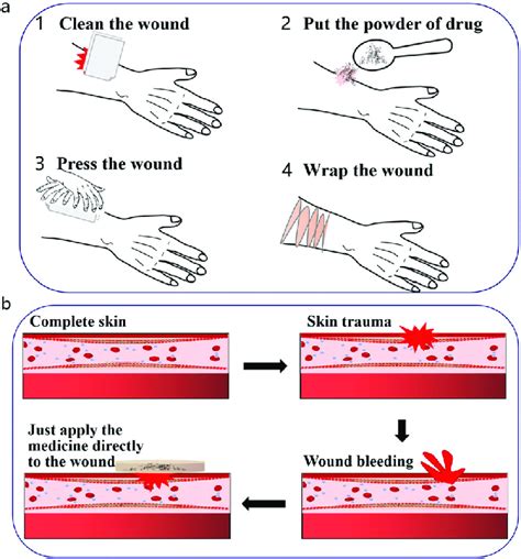 Schematic Diagram Showing The Application Of Powder Type Hemostatic