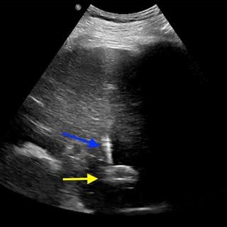 Ultrasound Guided Transhepatic Access Caption Ultrasound Is Used To