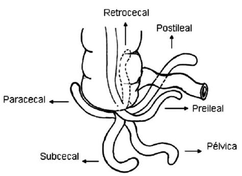 Apendicitis Aguda Apendicitis Aguda Anatom A Del Ap Ndice El Ap Ndice