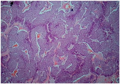 Metastatic Small Cell Carcinoma Of The Lung With Prominent Spindle Cell