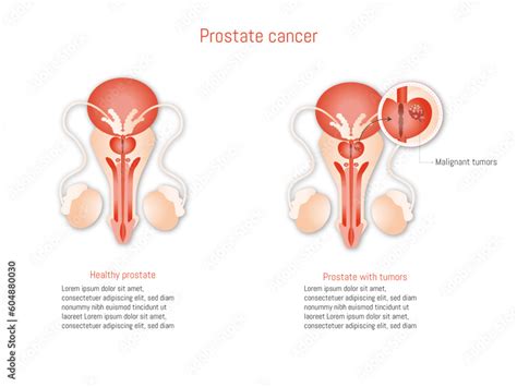 Prostate cancer infographic on white background illustration. Anatomy ...