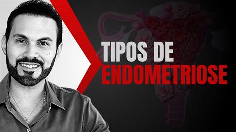 Conheça os TIPOS DE ENDOMETRIOSE Dr André Vinícius YouTube